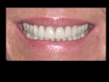 After Whitening, Before Bonding and Veneers