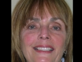 Veneers