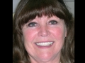 Veneers