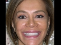 Veneers