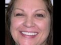 Whitening, Bonding and Lumineers