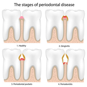 stages of periodontal disease 
