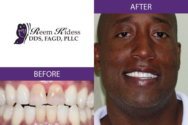 Before and After Image of cosmetic dentistry