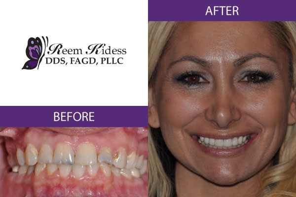 before and after image of cosmetic dentistry