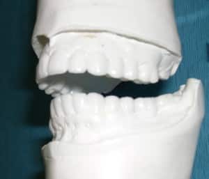 diagnostic wax up