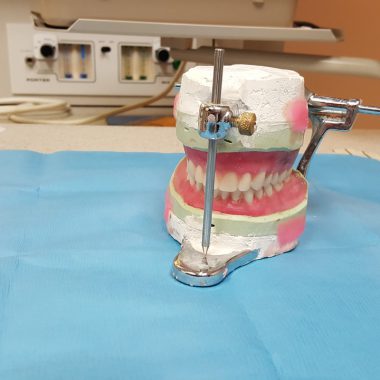 fixed partial denture