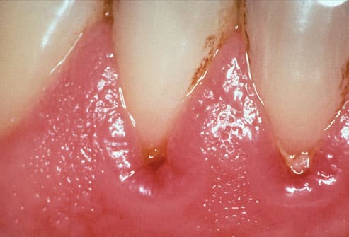 early stages of gum disease