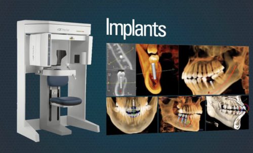 Educational videos for Dental Implants
