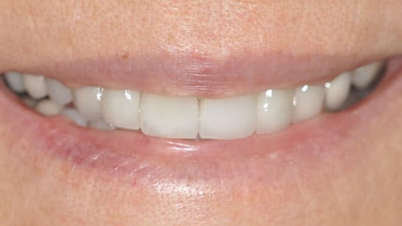 model of teeth with cerec crowns