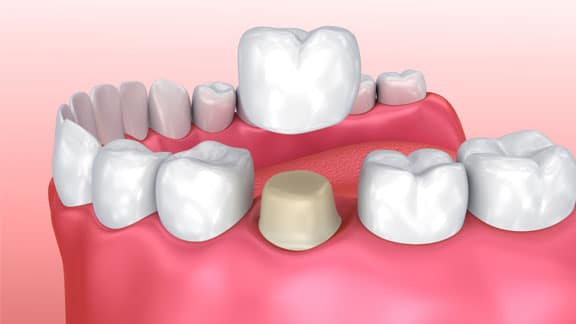 model of teeth for cerec crowns