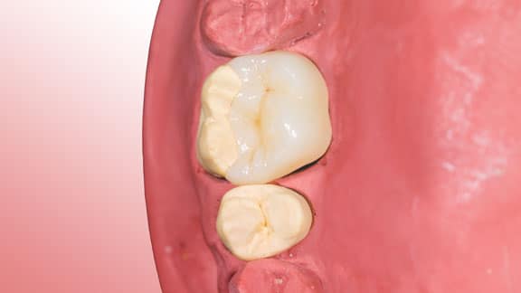 model of teeth for cerec crowns
