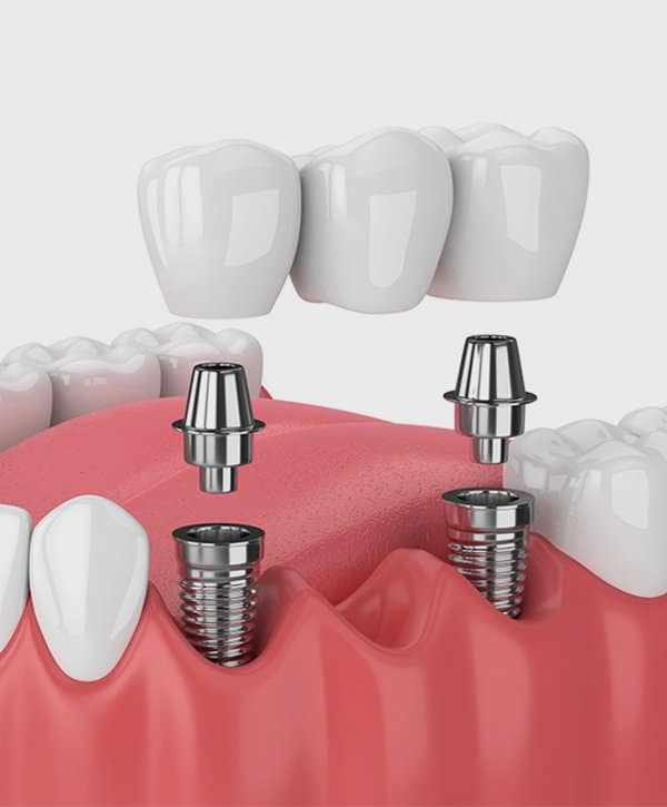 Full Dental Implants Scottsdale