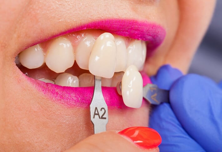 dental veneers Scottsdale