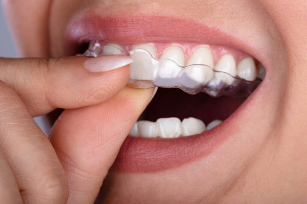 Person demonstrating teeth whitening strips application on upper teeth, smiling widely to show dental results.