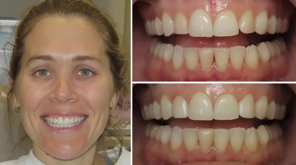 Woman smiling at camera with close-up dental before-and-after comparisons showing teeth whitening results.