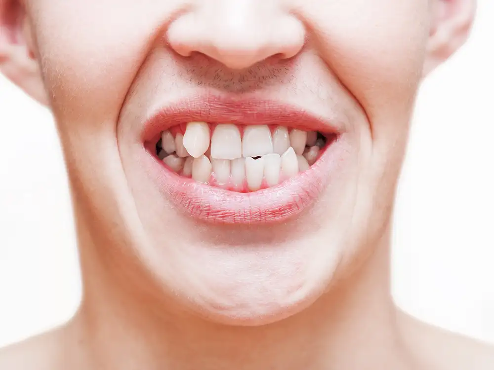 Close-up of person smiling, displaying teeth and gums against white background.