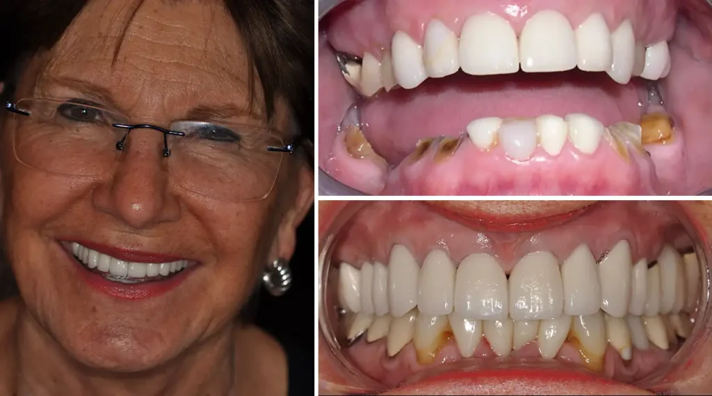 Woman smiling wearing glasses; close-up dental photos showing before and after teeth whitening results.