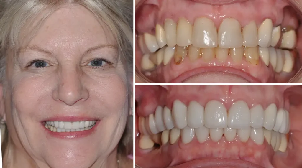 Before and after dental transformation showing woman's smile improvement and teeth whitening results.
