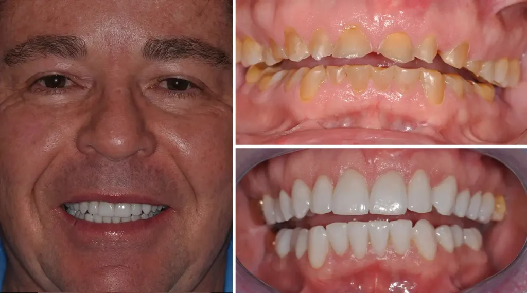 Man's smile transformation showing before and after dental work results with improved teeth alignment and whiteness.