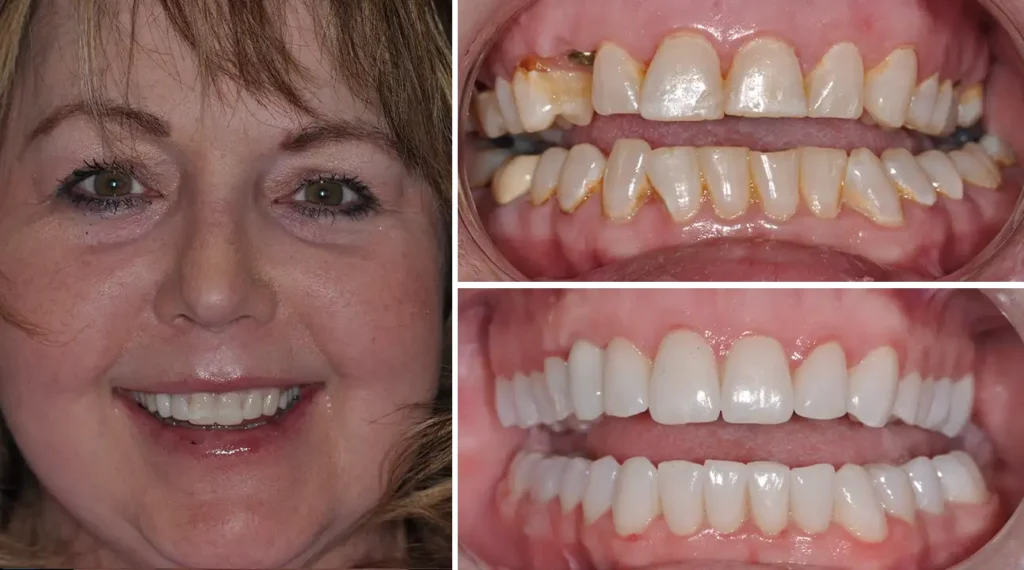 Before and after dental transformation showing woman's smile improvement through professional teeth whitening and cosmetic dentistry treatment.