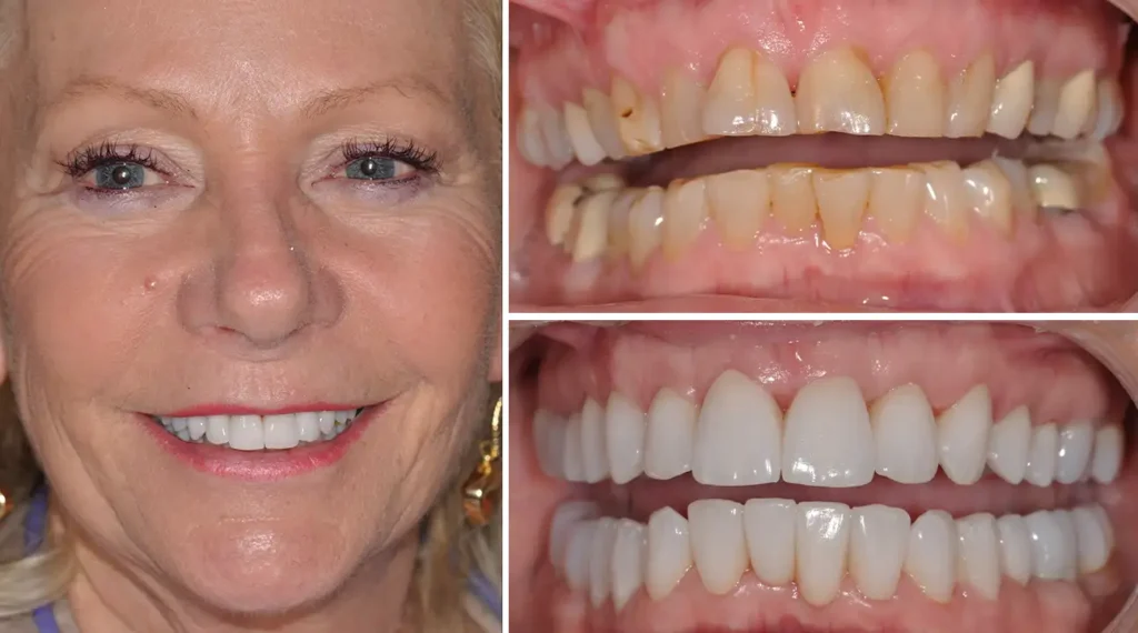 Woman's smile transformation showing before and after dental work results.