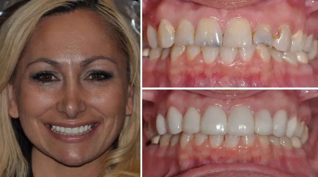 Woman's smile transformation showing before and after dental treatment results with improved tooth alignment and appearance.