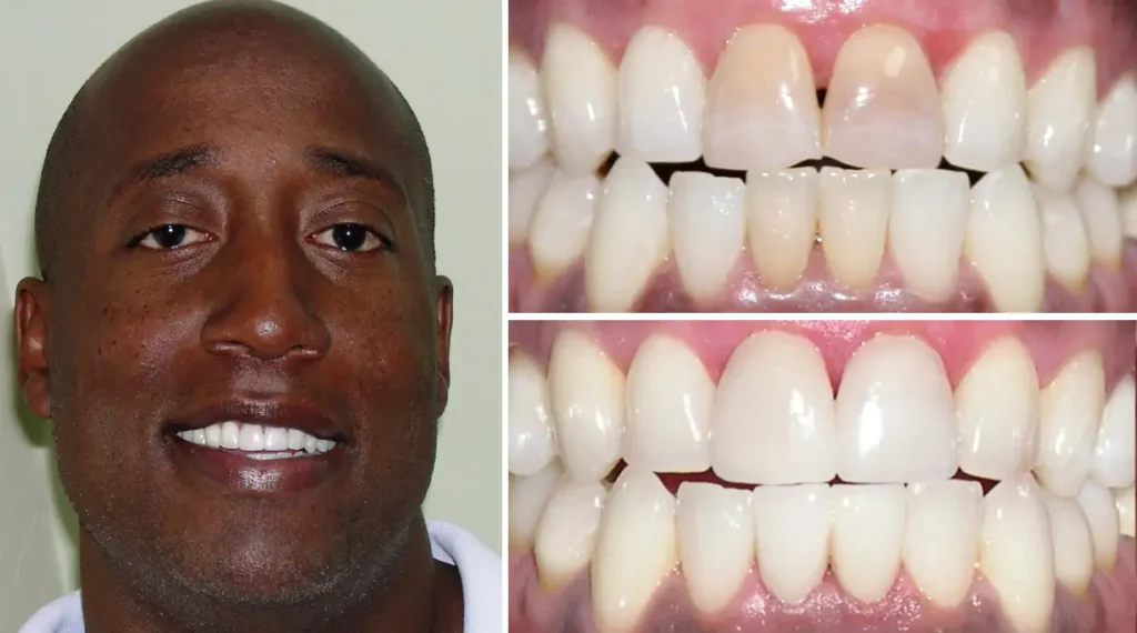 Man smiling at camera alongside close-up dental images showing before and after teeth alignment results.