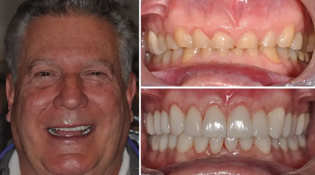 Man smiling before and after dental work showing improved tooth appearance and alignment.