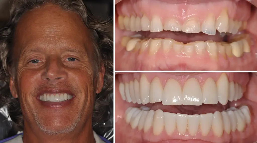 Before and after dental smile transformation showing improved tooth alignment and whitening results.