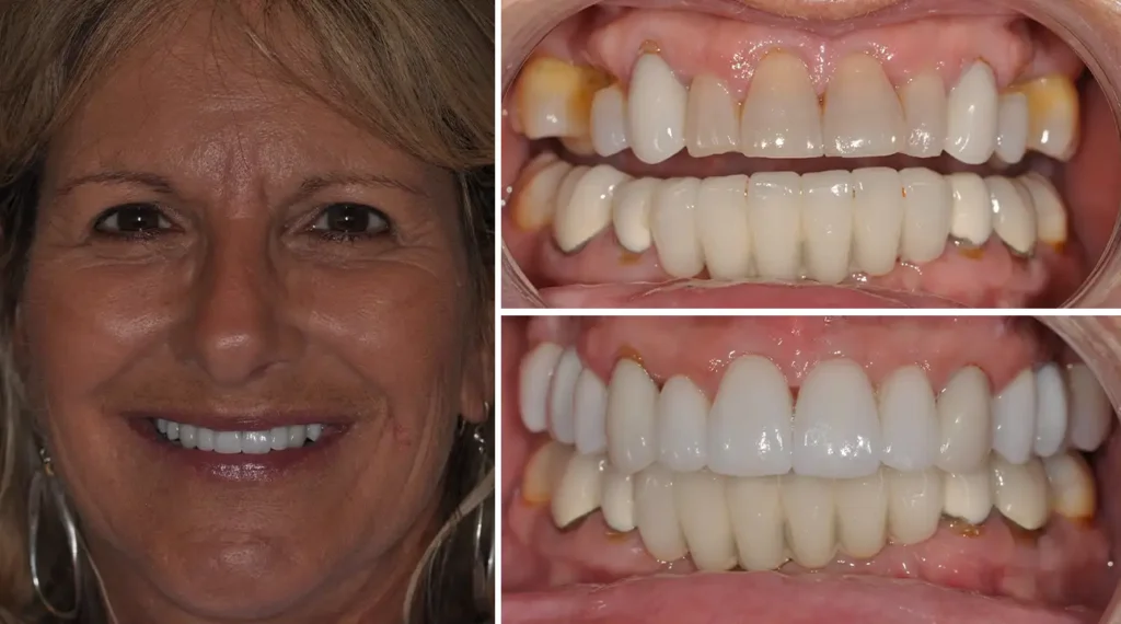 Woman smiling showing before and after dental veneers results in close-up comparison photos.