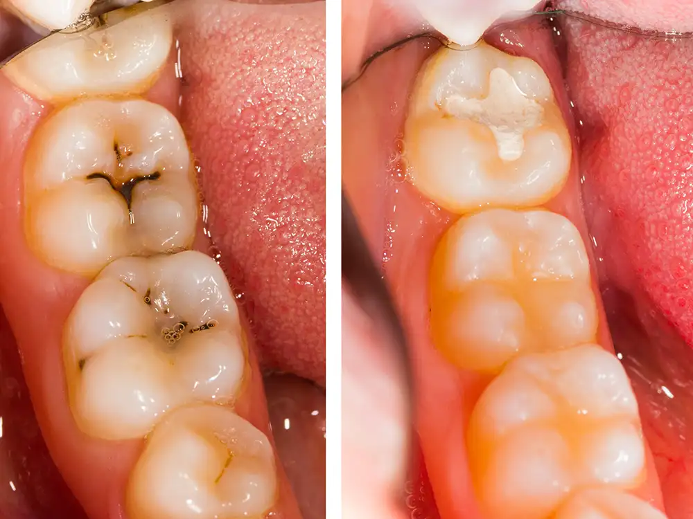 Close-up dental comparison showing tooth surfaces with varying degrees of discoloration and decay patterns in oral cavity.