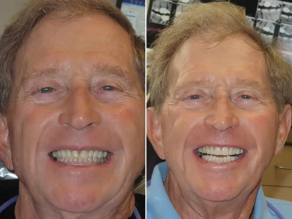 Before and after dental treatment comparison showing two smiling men with improved teeth at PV Smiles.