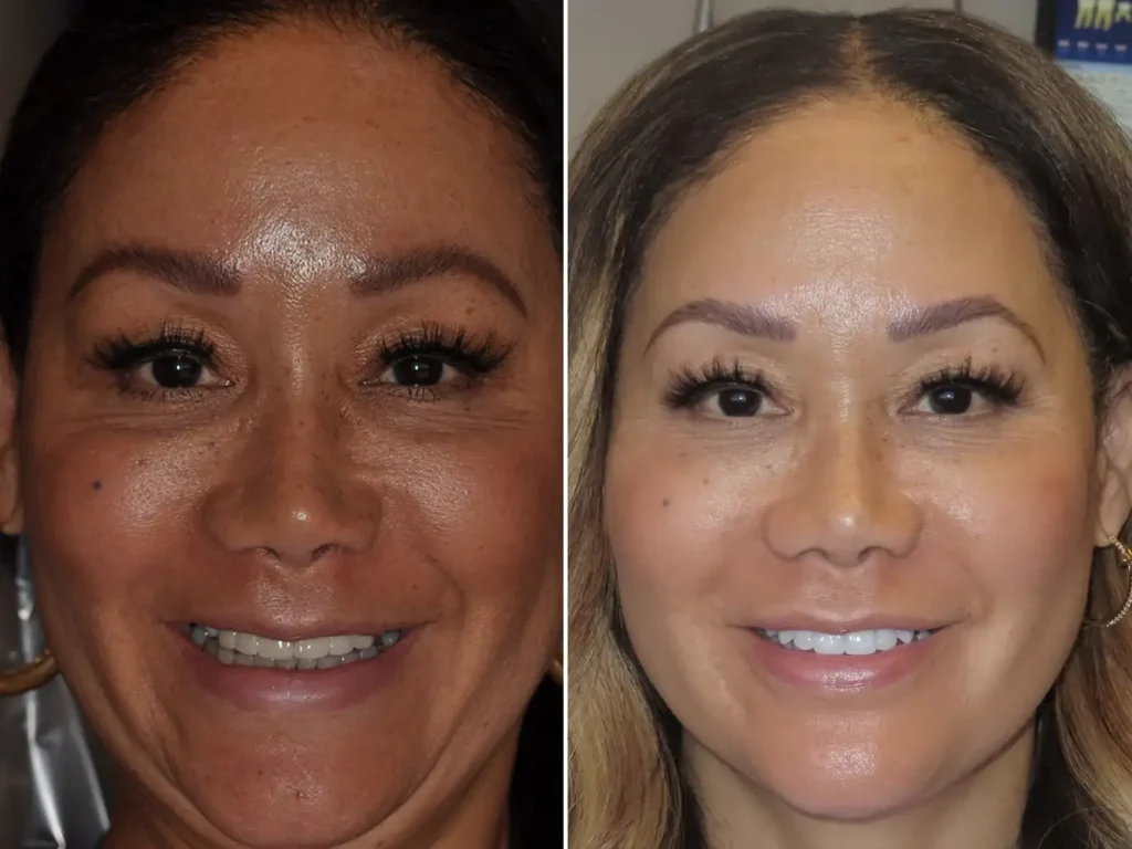 Before and after dental transformation showing woman's improved smile and teeth whitening results.
