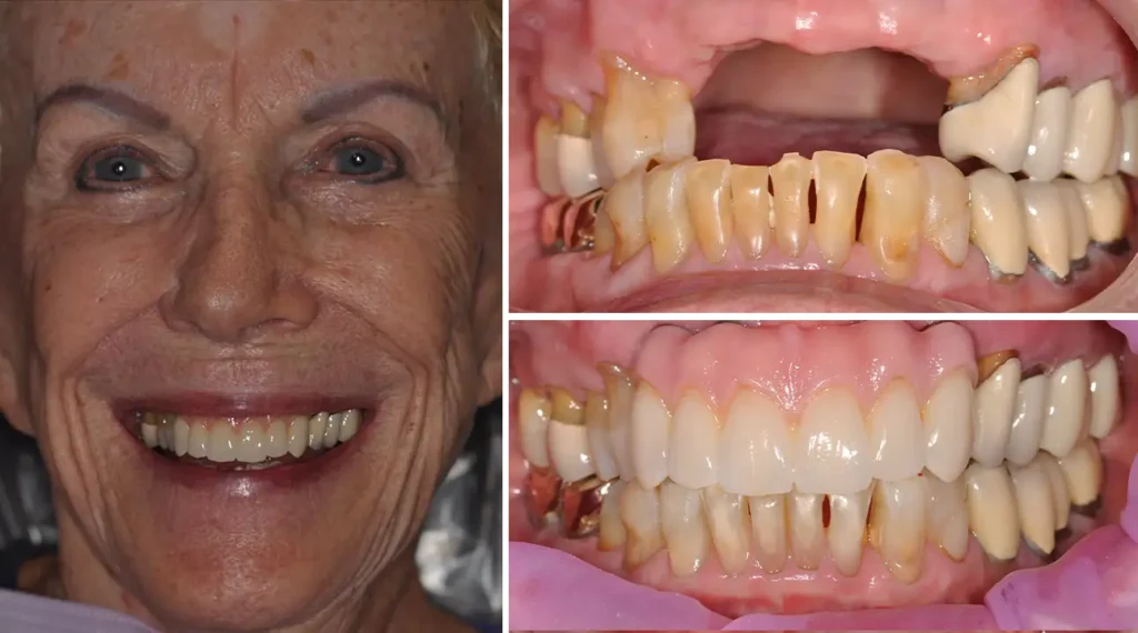 Before and after dental transformation showing smile improvement and teeth whitening results.