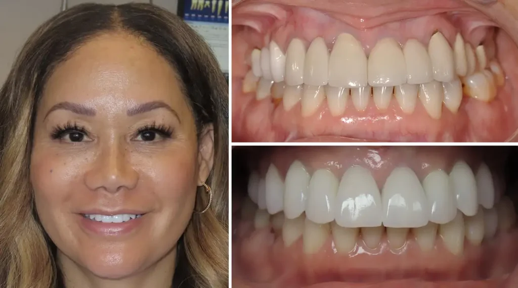 Woman's smile transformation showing before and after dental treatment results at PV Smiles