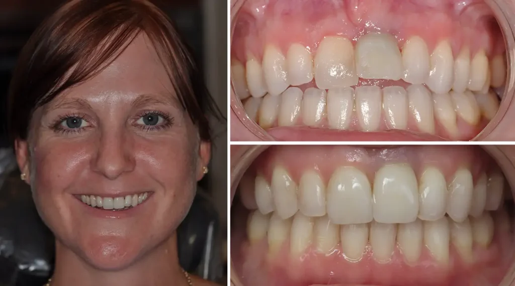 Woman smiling at camera with before and after dental treatment photos showing improved tooth alignment and whitening.