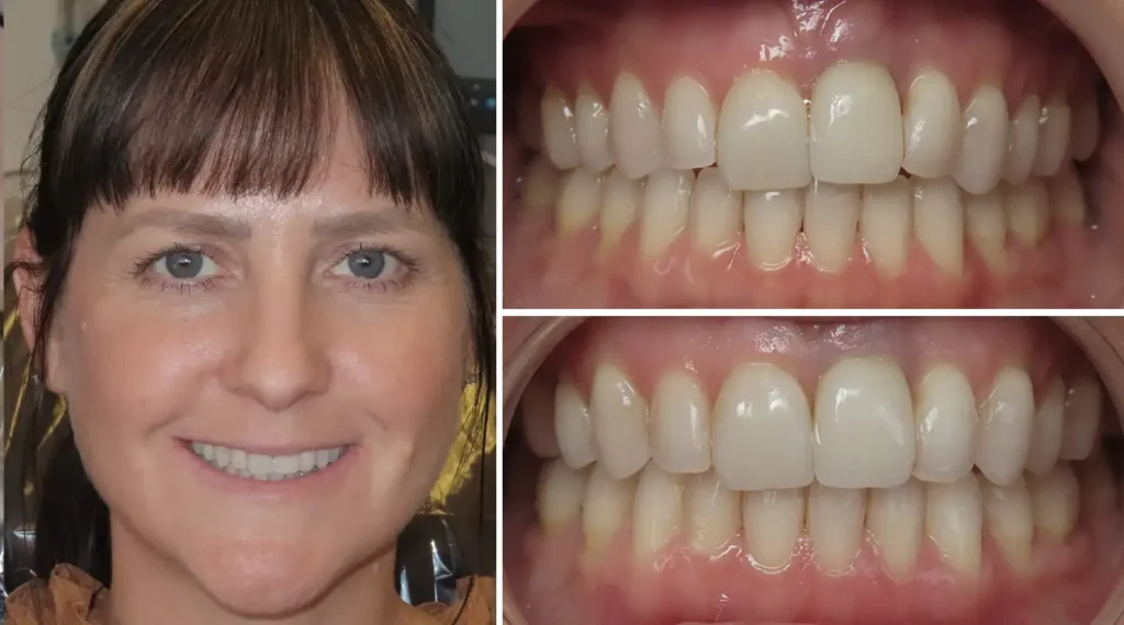 Woman's smile transformation showing before and after dental work results.
