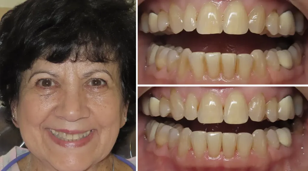 Woman smiling at camera with dental before and after comparison photos showing tooth whitening results.