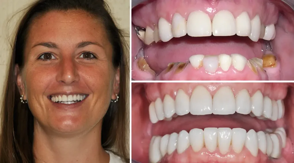 Before and after dental treatment showing woman's smile improvement and closeup teeth whitening results.