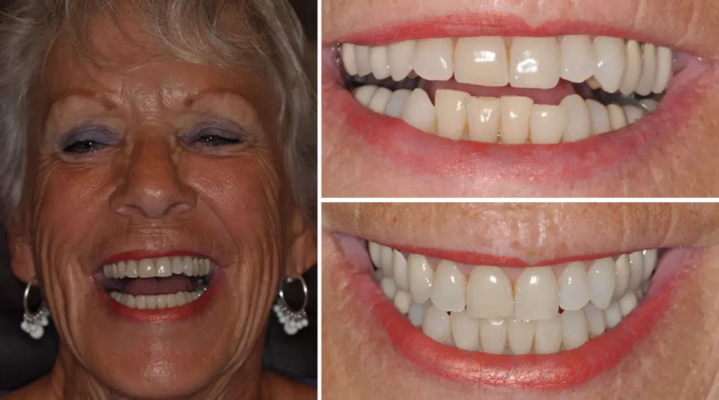 Before and after dental smile transformation showing woman's improved teeth whiteness and alignment.