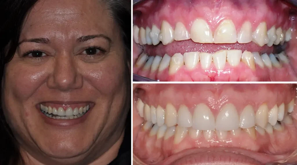 Woman smiling showing before and after dental treatment results with improved tooth alignment and whiteness.