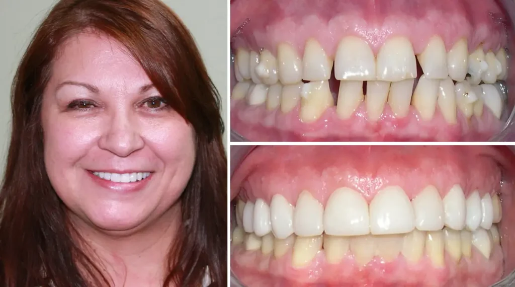Before and after dental transformation showing woman's smile improvement from gap teeth to aligned white teeth.