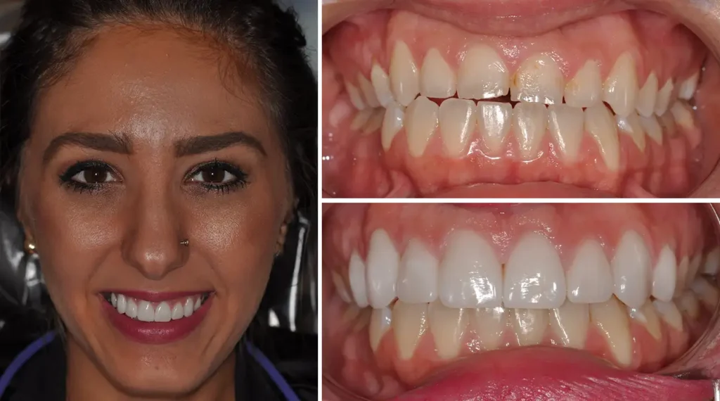 Woman's smile transformation showing before and after dental treatment results at PV Smiles.