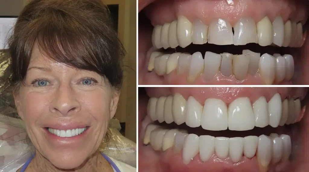 Woman smiling at camera; before and after dental veneers showing improved tooth appearance and alignment.