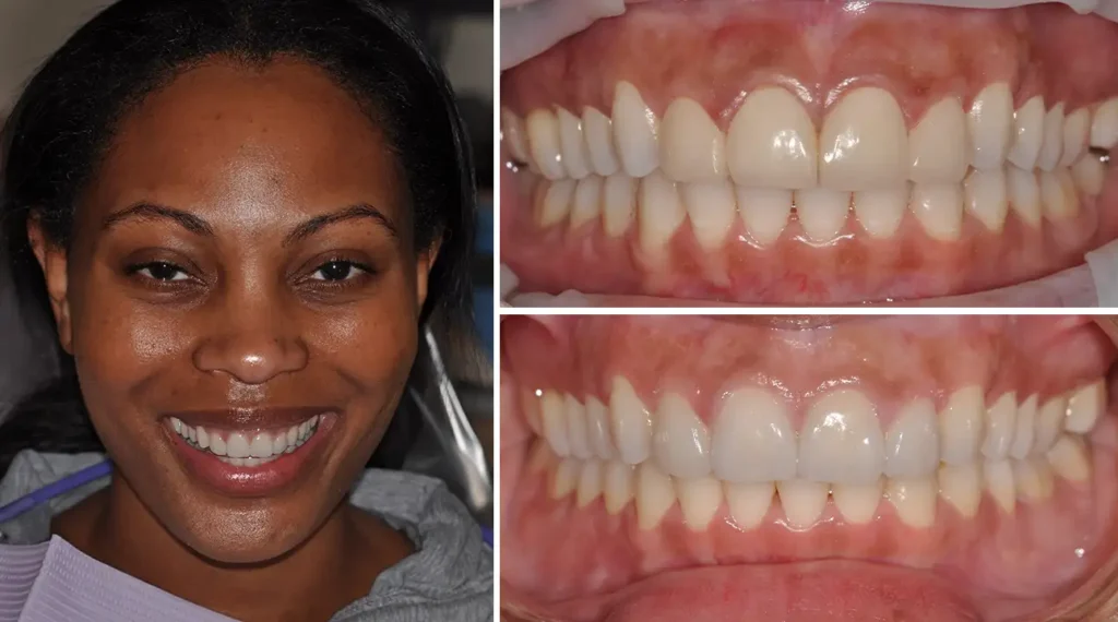 Woman smiling at camera; close-up dental photos showing upper and lower teeth alignment.