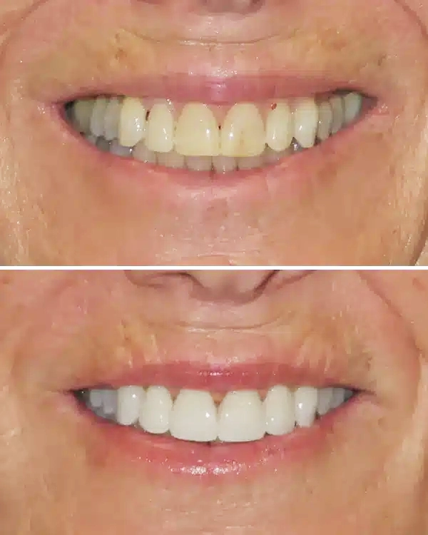 Before and after comparison of teeth whitening results showing improved brightness and whiteness.