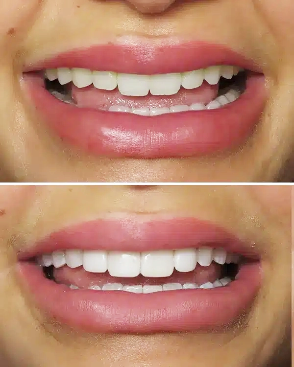 Before and after comparison of smile makeover showing improved tooth alignment and whiteness.