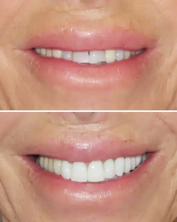 Before and after smile comparison showing teeth whitening results at PV Smiles dental practice.