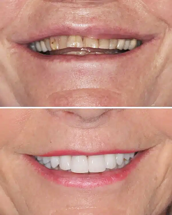 Before and after dental transformation showing improved teeth whiteness and smile aesthetics