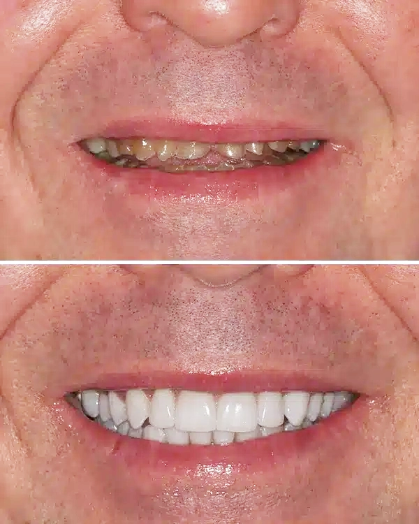 Before and after dental treatment showing improved tooth appearance and smile transformation.